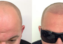 La Micropigmentación del Cuero Cabelludo y Sus Beneficios La Micropigmentación del Cuero Cabelludo y Sus Beneficios