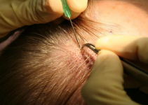 ¿Es el Transplante Capilar una Solución para la Falta de Cabello? ¿Es el Transplante Capilar una Solución para la Falta de Cabello?