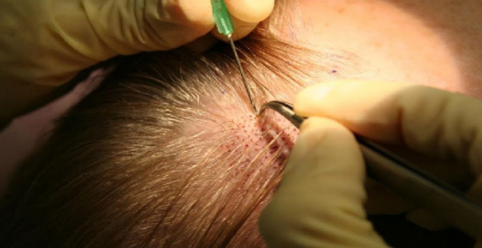 ¿Es el Transplante Capilar una Solución para la Falta de Cabello?
