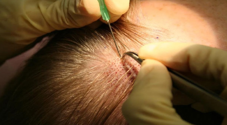 Microtrasnplante de Cabello