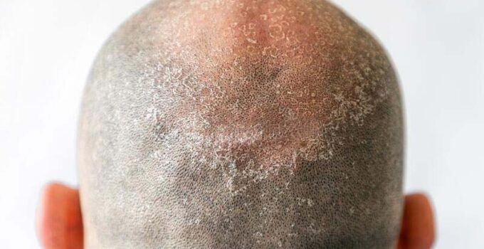 Cómo Tratar un Cuero Cabelludo Quemado Por el Sol